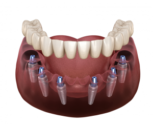 All-on-6 dental implants for full-arch tooth restoration